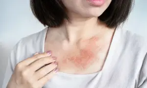 Pelle arrossata e irritata sul petto, sintomo di dermatite da sudore.