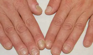 Mani con unghie che mostrano ispessimento e alterazioni del colore, con evidenti pellicine intorno alle unghie.