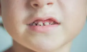 Primo piano del viso di un bambino con macchie bianche sulla pelle e denti da latte visibili.