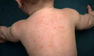 Schiena di un neonato coperta da piccole bolle da sudore rosse.