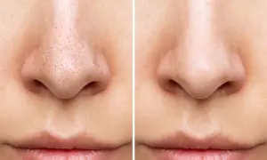 Prima e dopo: come togliere i punti neri dal naso in casa. Il naso appare più pulito e liscio.