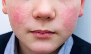 Primo piano del viso di un bambino con guance rosse e calde, forse per il freddo o un'allergia.