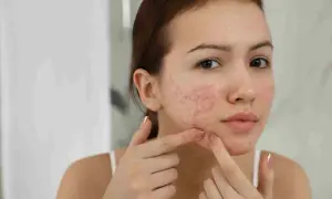 Ragazza con acne in gravidanza, si tocca il viso con le dita.