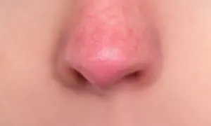 Primo piano di un naso rosso, con la pelle leggermente arrossata e pori visibili.