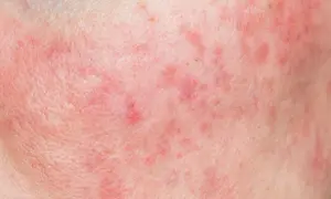 Pelle arrossata con piccole macchie rosse e pori dilatati, segno di ipersensibilità cutanea.