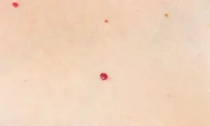 Pelle chiara con piccole macchie rosse, come rubini apparsi nei rossi all'improvviso, e una più scura.