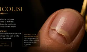 Unghia con onicolisi: la pellicina si stacca dal letto ungueale, mostrando un'area biancastra.