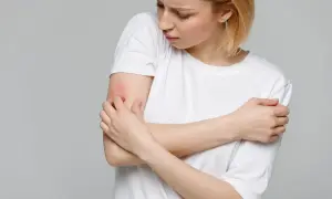 Ragazza con prurito alle braccia in estate, la pelle arrossata e irritata.