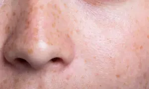 Primo piano del viso con ipomelanosi guttata. Si cercano rimedi per queste macchie cutanee.