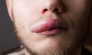 Labbro superiore gonfio improvviso, sintomo di angioedema. La pelle appare tesa e arrossata.