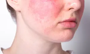 Guance arrossate e visibili sfoghi sul viso da stress, con labbra leggermente secche.