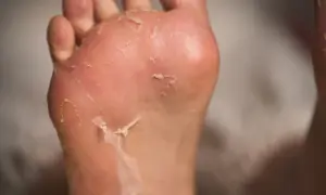 Primo piano di piedi che si spellano, con la pelle secca che si stacca dalla pianta e dalle dita.