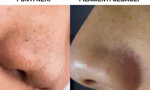 Primo piano del naso con punti neri e filamenti sebacei, un problema comune che si riforma sempre.
