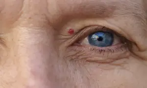 Un occhio azzurro con un neo rosso sulla pelle, circondato da rughe.
