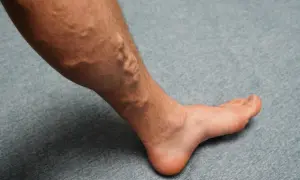 Gamba con vene varicose evidenti, un segnale che potrebbe richiedere rimedi per gambe gonfie.