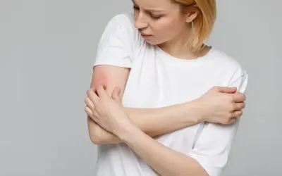 Ragazza con prurito alle braccia in estate, la pelle arrossata e irritata.