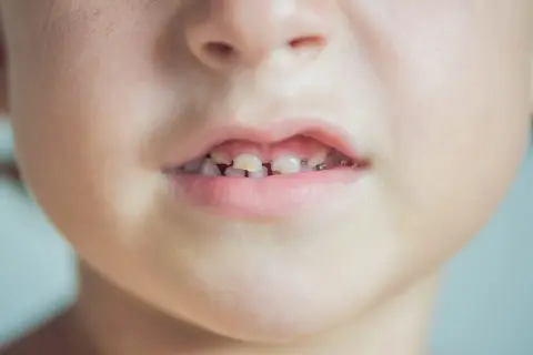 Primo piano del viso di un bambino con macchie bianche sulla pelle e denti da latte visibili.