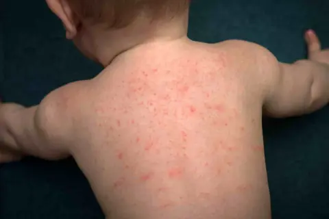 Schiena di un neonato coperta da piccole bolle da sudore rosse.