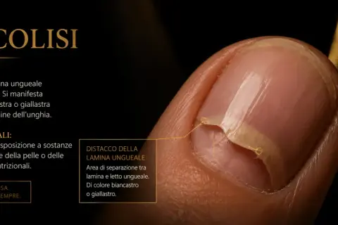 Unghia con onicolisi: la pellicina si stacca dal letto ungueale, mostrando un'area biancastra.