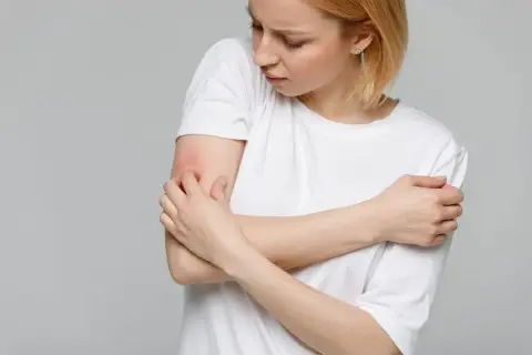 Ragazza con prurito alle braccia in estate, la pelle arrossata e irritata.