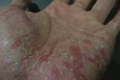 Mani spellate con pelle secca e screpolata, arrossate e desquamate. Possibili cause di questo disturbo cutaneo.