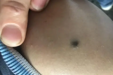 Dito, un dito indica un **punto nero gigante** sulla pelle.