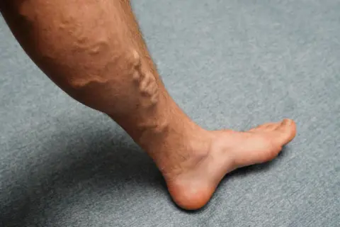 Gamba con vene varicose evidenti, un segnale che potrebbe richiedere rimedi per gambe gonfie.