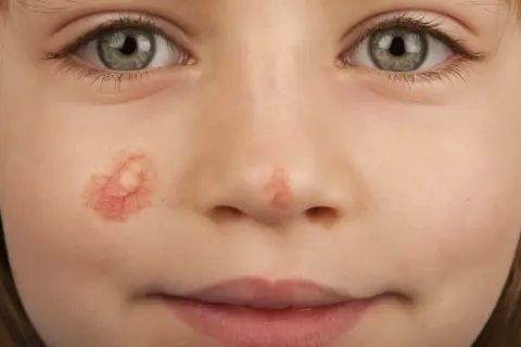 Primo piano del viso di una bambina con un angioma rubino sulla guancia. Si cercano rimedi naturali per questa condizione.