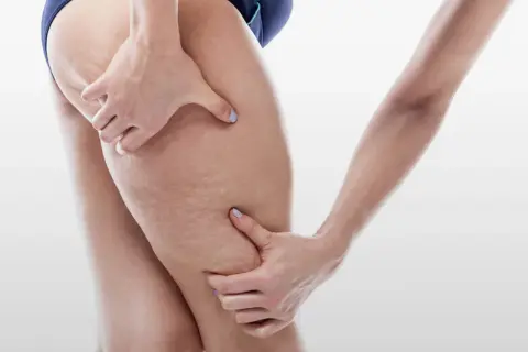 Mani che stringono la coscia, mostrando la pelle con aspetto a buccia d'arancia, sintomo di ritenzione idrica cause.