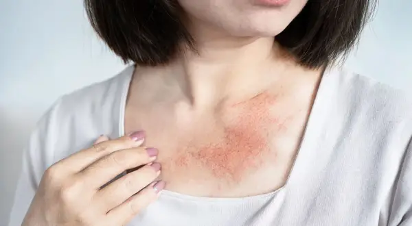 Pelle arrossata e irritata sul petto, sintomo di dermatite da sudore.