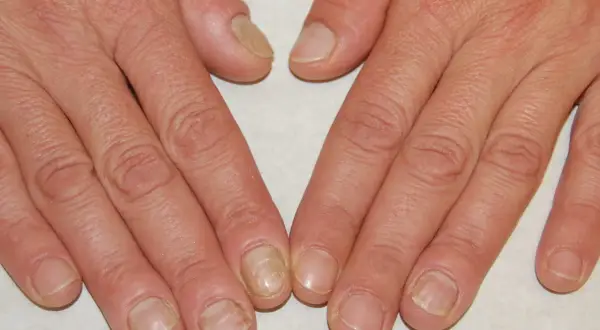 Mani con unghie che mostrano ispessimento e alterazioni del colore, con evidenti pellicine intorno alle unghie.