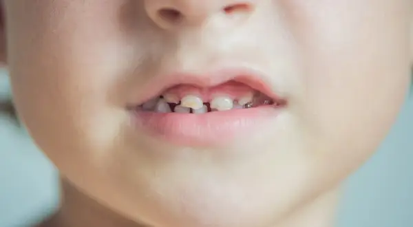 Primo piano del viso di un bambino con macchie bianche sulla pelle e denti da latte visibili.
