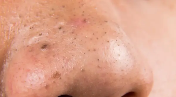 Primo piano del naso con pori dilatati e punti neri. Si nota un punto nero infiammato con un alone rossastro.