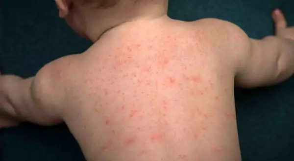 Schiena di un neonato coperta da piccole bolle da sudore rosse.