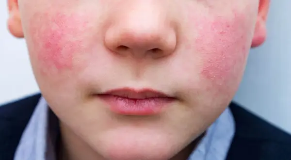 Primo piano del viso di un bambino con guance rosse e calde, forse per il freddo o un'allergia.