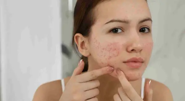 Ragazza con acne in gravidanza, si tocca il viso con le dita.