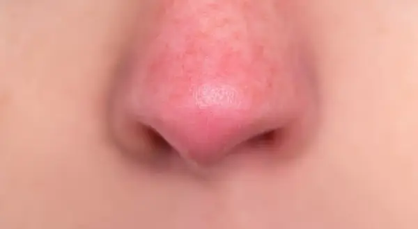 Primo piano di un naso rosso, con la pelle leggermente arrossata e pori visibili.