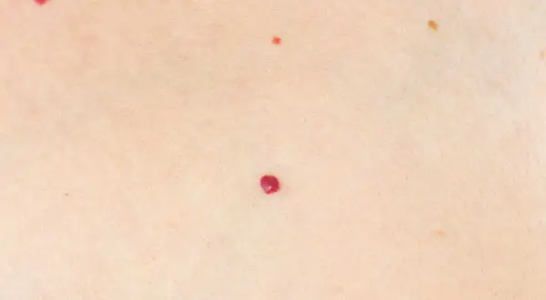 Pelle chiara con piccole macchie rosse, come rubini apparsi nei rossi all'improvviso, e una più scura.