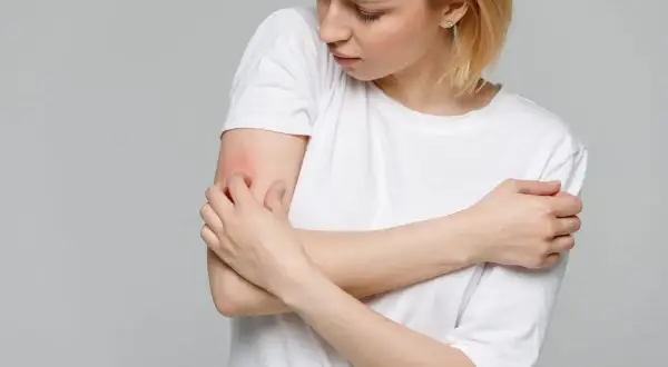 Ragazza con prurito alle braccia in estate, la pelle arrossata e irritata.