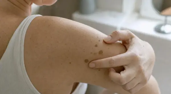 Dita che indicano macchie scure sulla pelle del braccio, evidenziando la texture e le diverse tonalità.