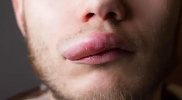 Labbro superiore gonfio improvviso, sintomo di angioedema. La pelle appare tesa e arrossata.
