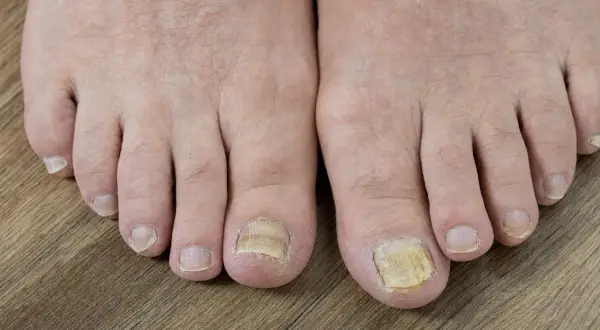 Piedi con unghie ispessite e ingiallite, possibili segni di micosi. La pelle morta sui piedi può avere varie cause.