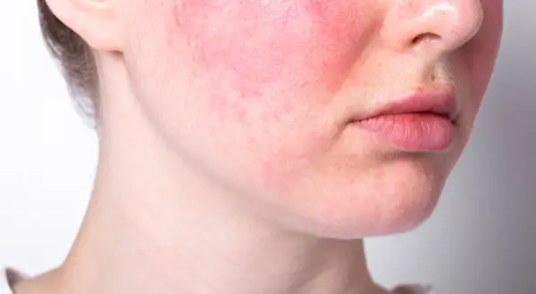 Guance arrossate e visibili sfoghi sul viso da stress, con labbra leggermente secche.