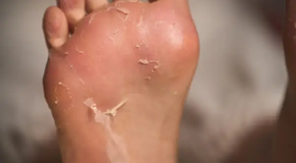 Primo piano di piedi che si spellano, con la pelle secca che si stacca dalla pianta e dalle dita.