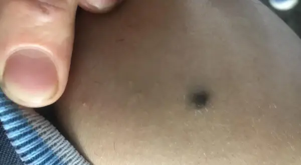 Dito, un dito indica un **punto nero gigante** sulla pelle.