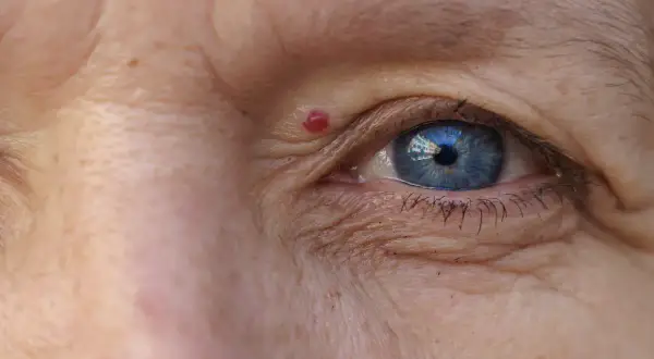 Un occhio azzurro con un neo rosso sulla pelle, circondato da rughe.