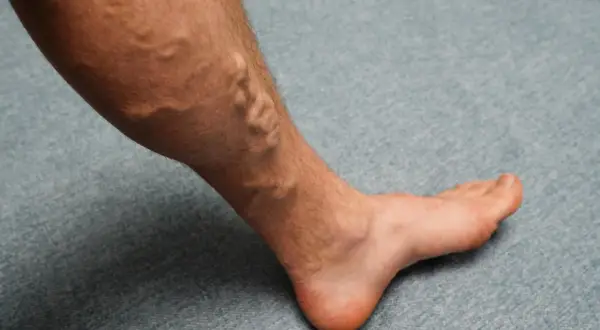 Gamba con vene varicose evidenti, un segnale che potrebbe richiedere rimedi per gambe gonfie.