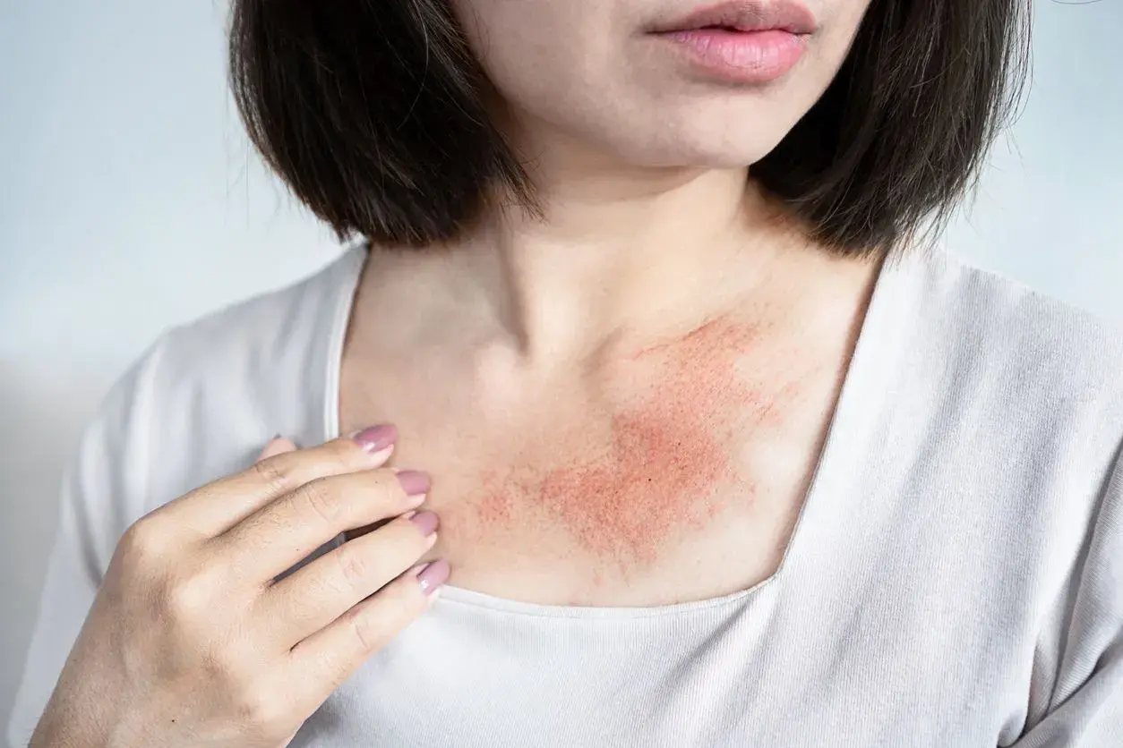 Pelle arrossata e irritata sul petto, sintomo di dermatite da sudore.