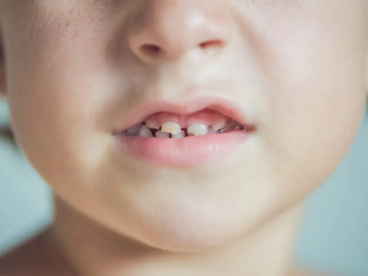 Primo piano del viso di un bambino con macchie bianche sulla pelle e denti da latte visibili.
