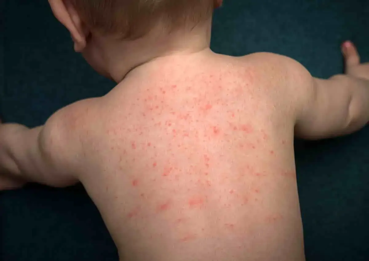 Schiena di un neonato coperta da piccole bolle da sudore rosse.